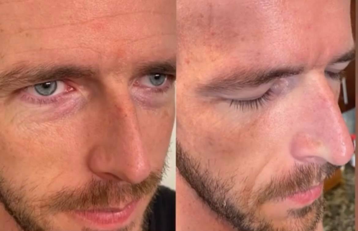 Før og efter billede Frownies Rynkeplaster til pande og ml. bryn, 144 plastre