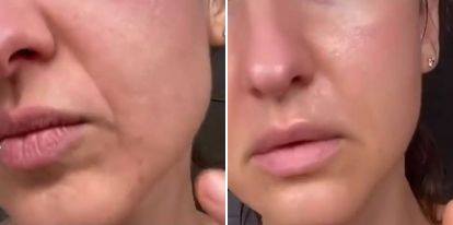 Frownies Rynkeplaster til smilerynker omkring mund og øjne, 144 plastre