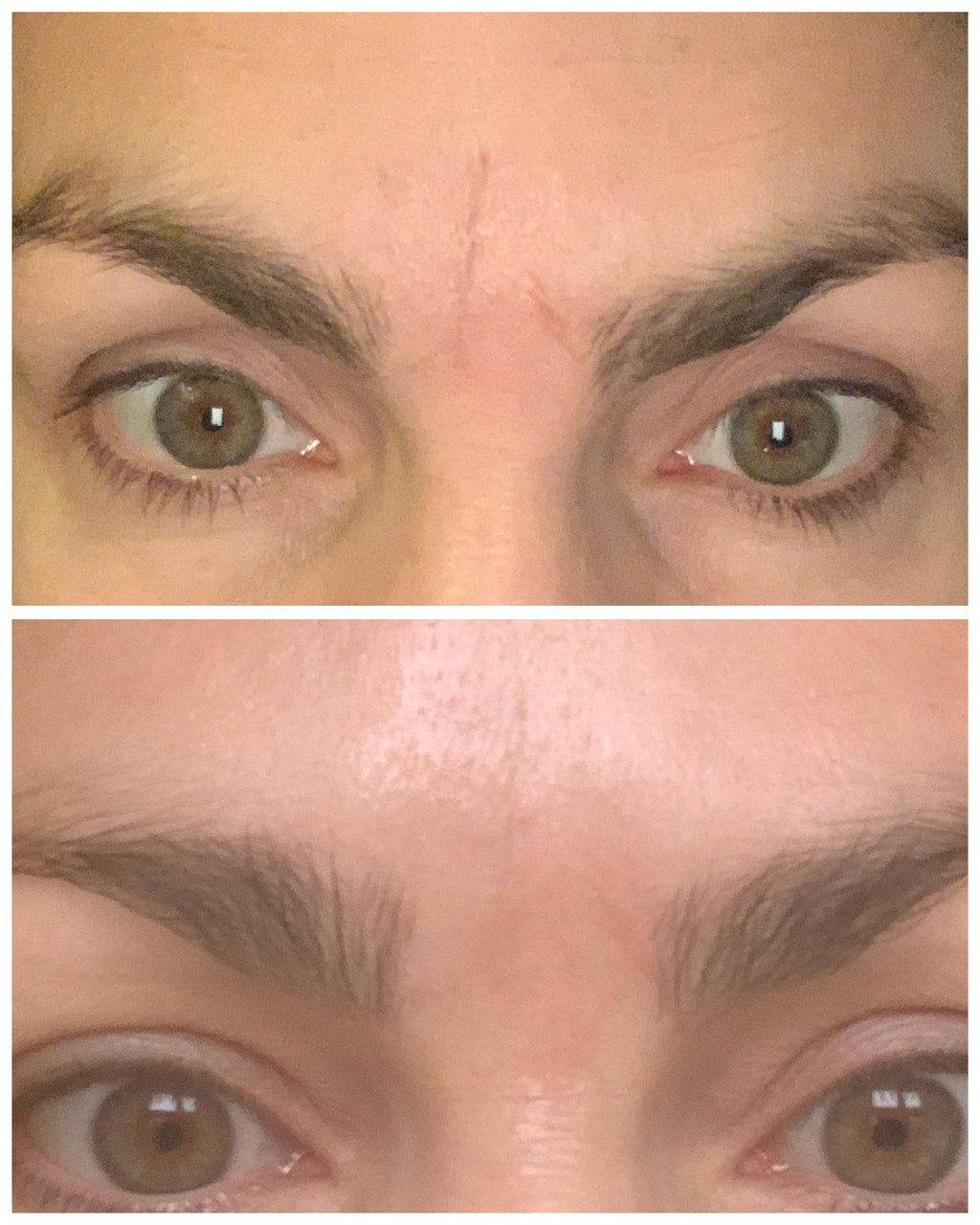 Før og efter billede Frownies Rynkeplaster til pande og ml. bryn, 144 plastre