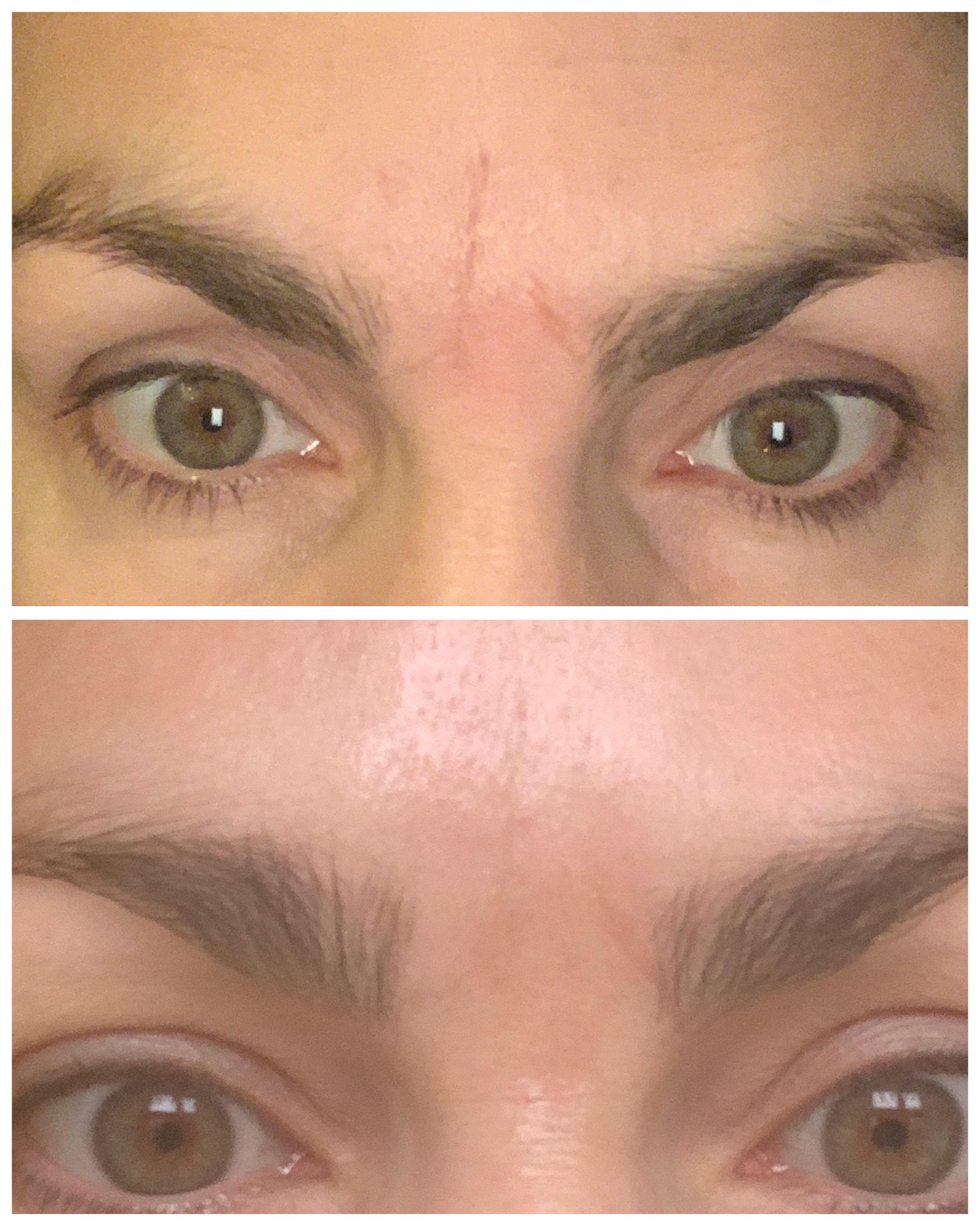 Før og efter billede Frownies Rynkeplaster til pande og ml. bryn, 144 plastre